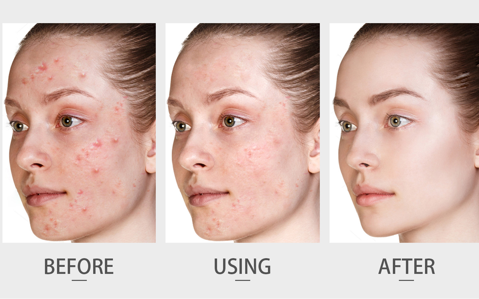 Acne-Care (3)