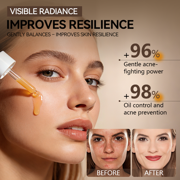 Acne-Clearing Essence Lotion